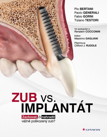Zub vs. implantát